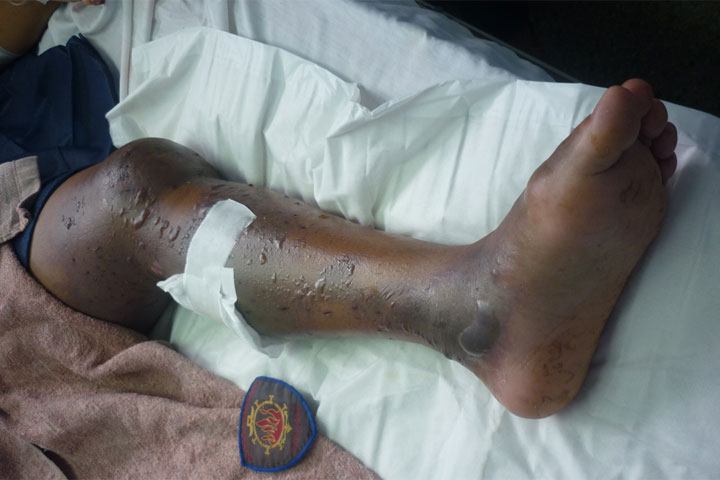 UN HOMBRE, QUE FUE MORDIDO POR UNA SERPIENTE TALLA X, MURIO